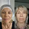 Полімолочна кислота