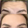 Ботулінотерапія Botox зона чола + міжбрівʼя