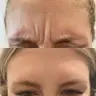 Ботулінотерапія Botox зона міжбрівʼя