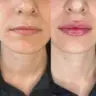 Контурна пластика губ Teosyal RHA KISS 0,7ml