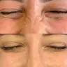 Ботулінотерапія «кролячих зморшок» Botox