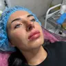 Контурна пластика губ Neuramis 1ml