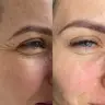 Ботулінотерапія Botox зони навколо очей «гусячі лапки»