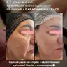 Апаратний ФУЛФЕЙС. Обличчя + очі (этап з апаратами)