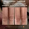 Рф ліфтинг та ультразвукова підтяжка з EMS