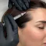 Мезотерапія (шкіра голови): Dermaheal HL-
