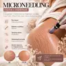 Microneedling: Narben Микронидлинг: шрамы и рубцы