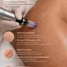 Microneedling: Dehnungsstreifen Микронидлинг: растяжки