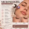Microneedling: Gesicht Микронидлинг: лицо