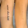 Séance de detatouage laser