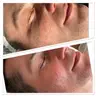 SAUERSTOFFBEHANDLUNG( Peeling)