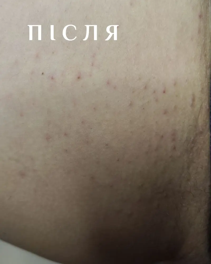 Студія електроепіляції EPIL.KO photo 3