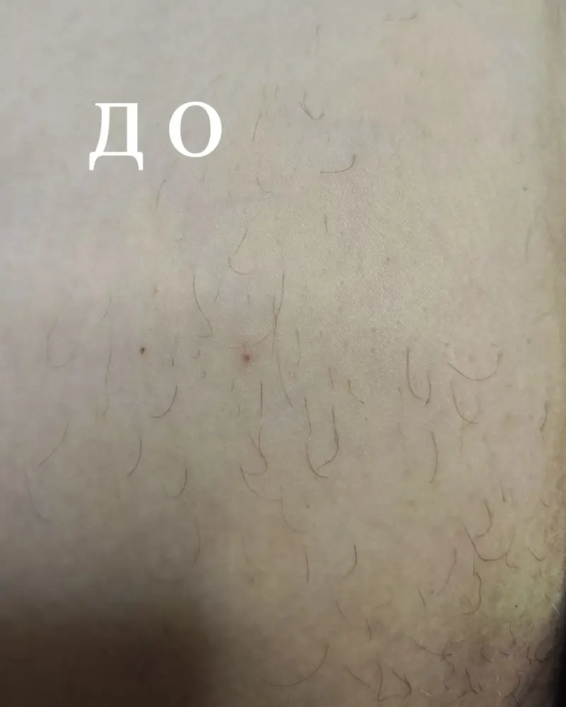 Студія електроепіляції EPIL.KO photo 2